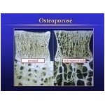 Osteoporose, Fracturas, Raquitis